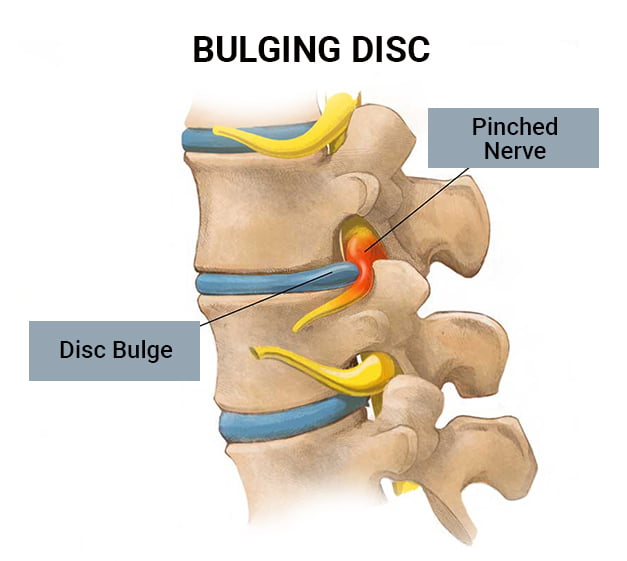 Cervical Disc Bulge in Jaipur: Neck Pain, Arm Tingling & Physiotherapy Management