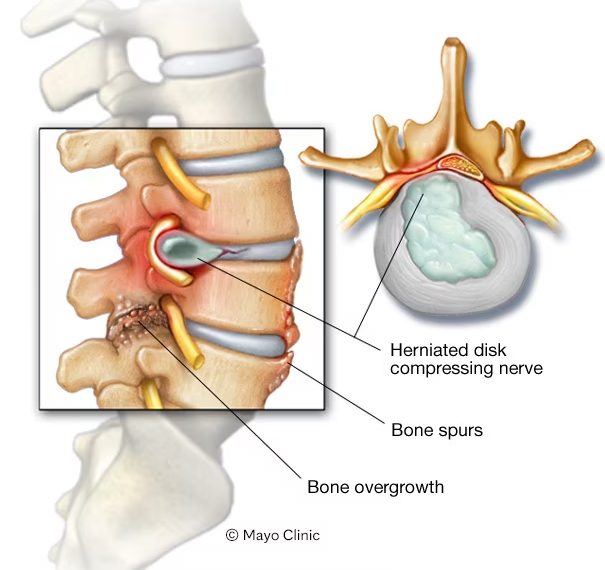 Spinal Stenosis in Jaipur: Symptoms, Walking Difficulties & Physiotherapy Options