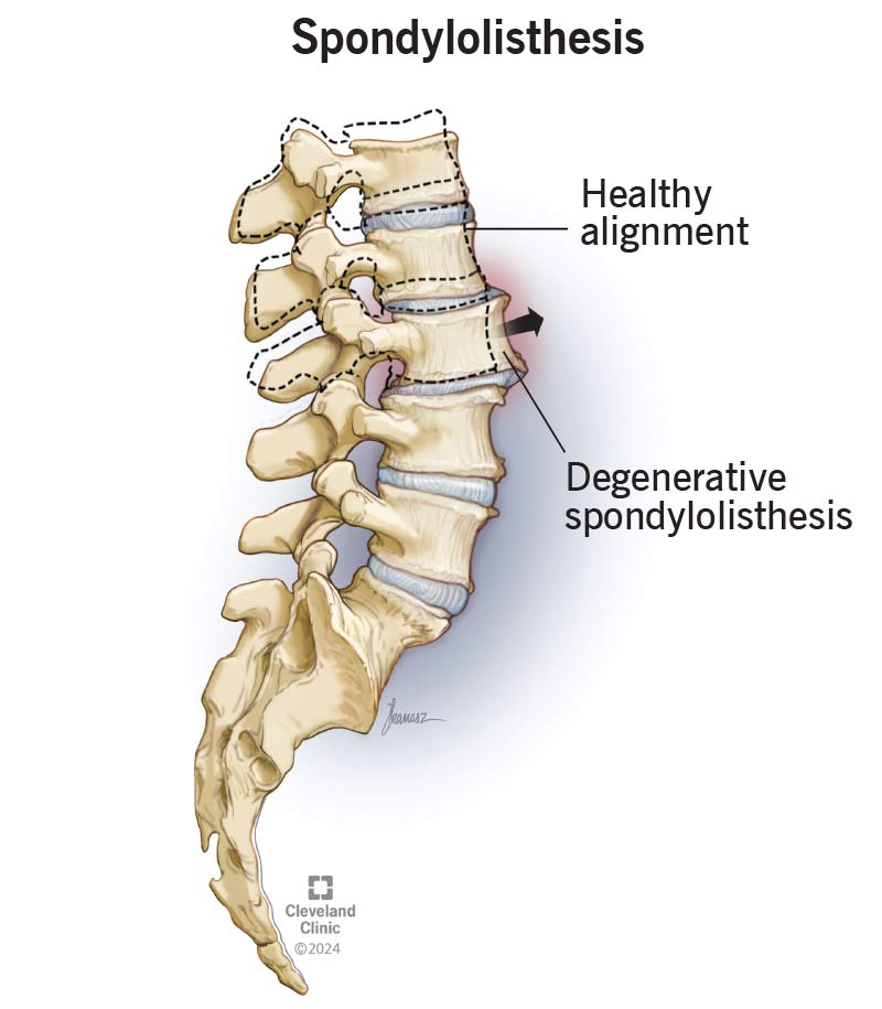 Spondylolisthesis Treatment in Jaipur | Spine Rehabilitation